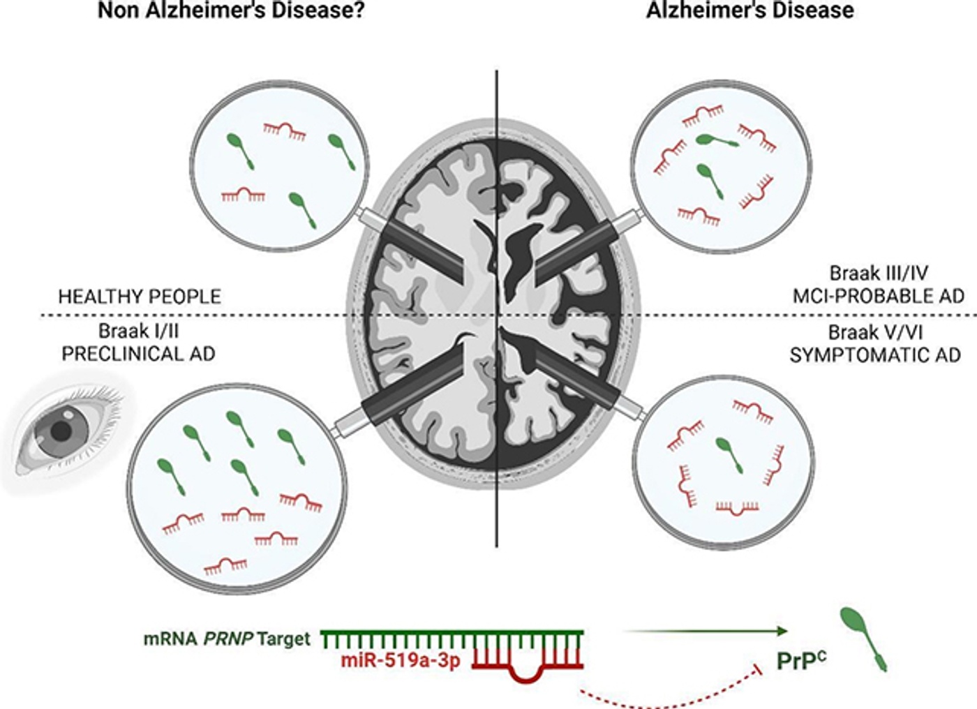 New Biomarker Discovery for Early Diagnosis of Alzheimer's Disease