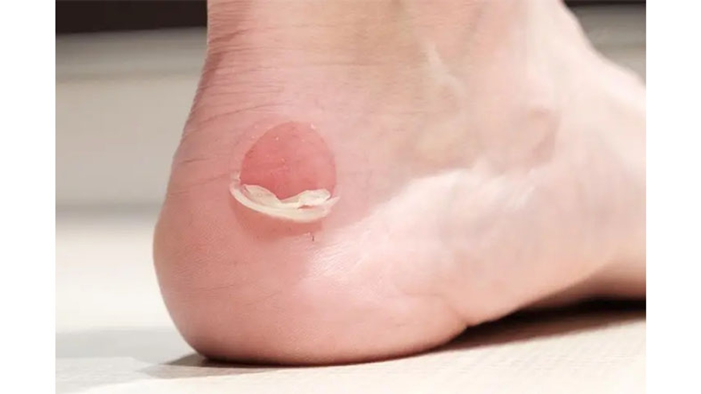 Why Shouldn't We Pop Water-Filled Blisters?