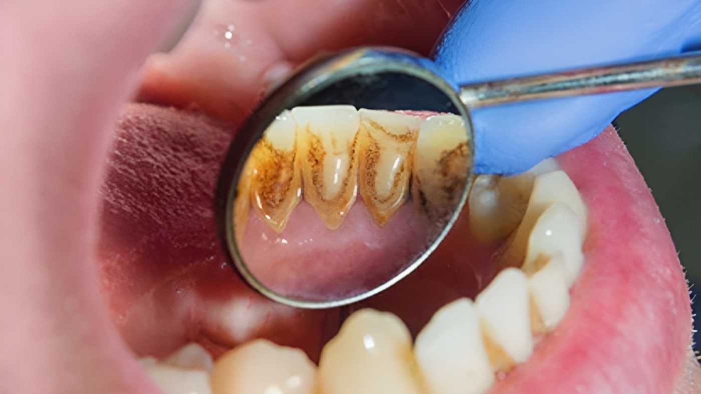 Long-Term Damages and Consequences of Not Brushing Your Teeth