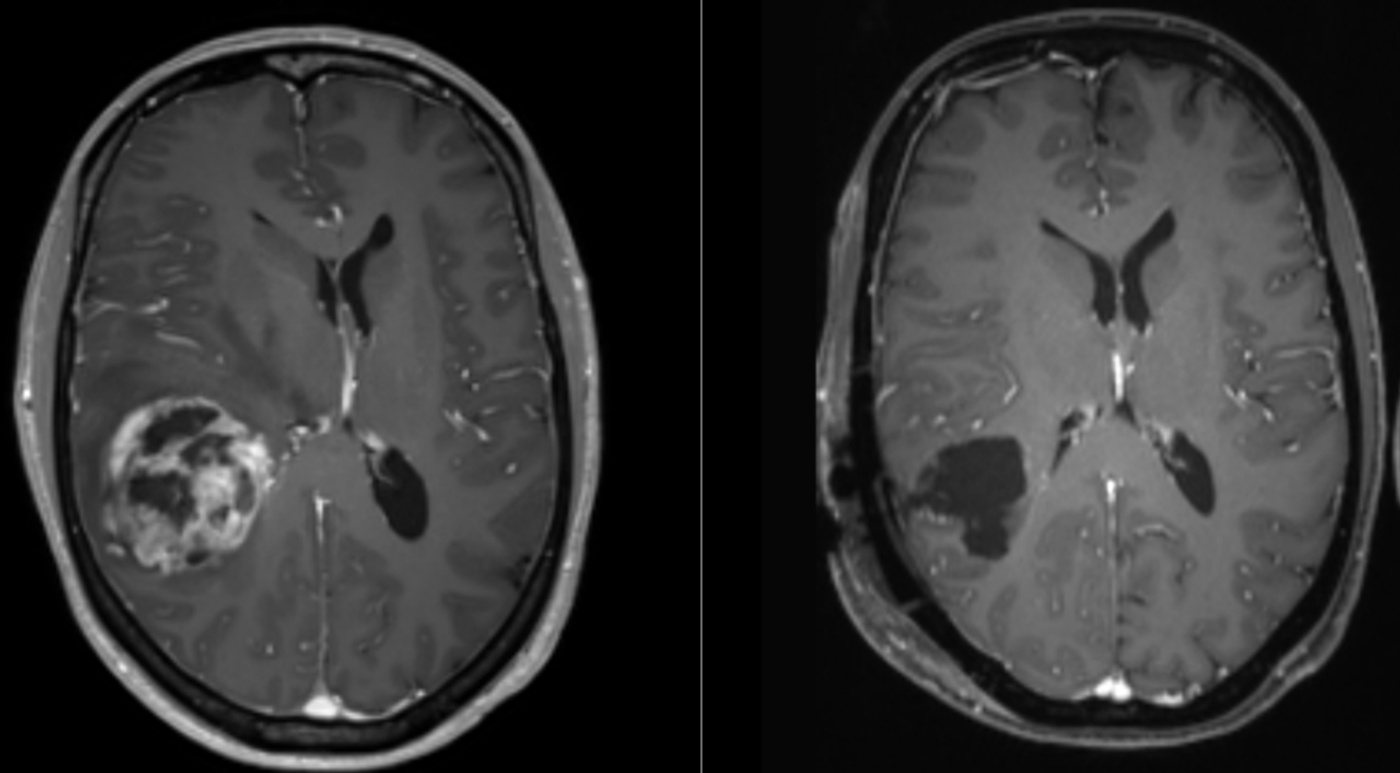 Immunotherapy May Be a Promising Method in the Treatment of Glioblastoma